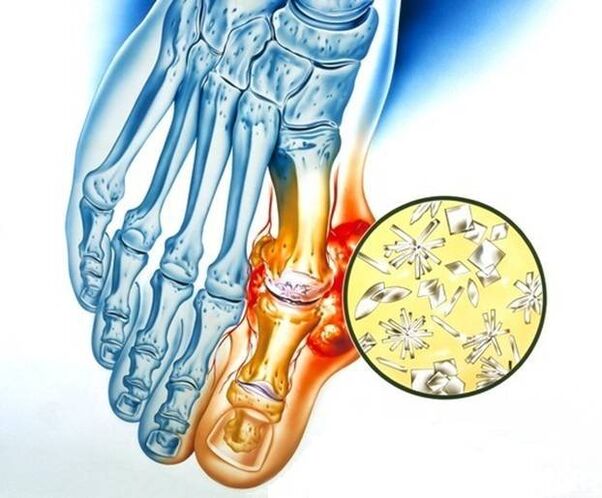 Uratablagerung bei Gout, verursaacht Entzündung am Gelenk